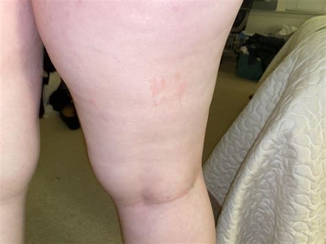 Painful spots on leg, feels like a burn : r/DermatologyQuestions