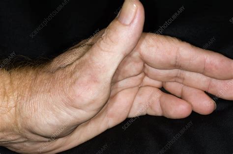 thumb  surgery  dislocation stock image  science