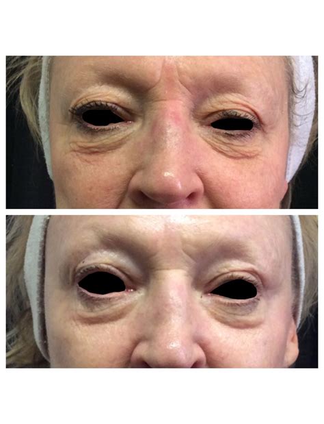 Ultherapy Before And After Photos Eyes