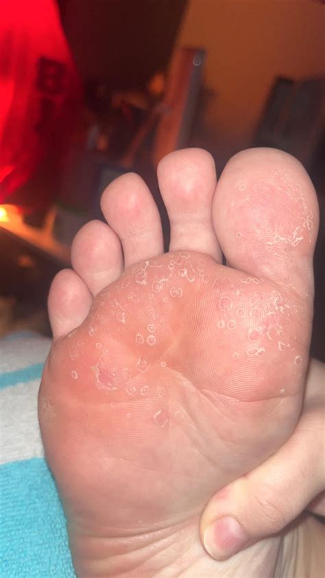 Is this pitted keratolysis or something else? : r/medical_advice