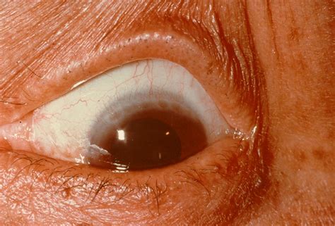 pannus  symptoms treatments  mum