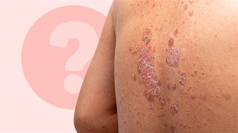 psoriasis   treatment