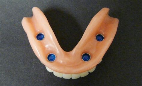 Dental Implant Supported Dentures – Sure-Fit Denture Clinic