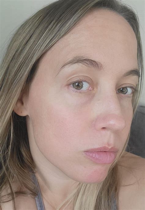 Before and after my first BBL treatment, 37F : r/30PlusSkinCare