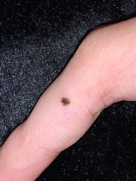 What Causes Dark Spots On Back Of Hands at Linda Fujiwara blog