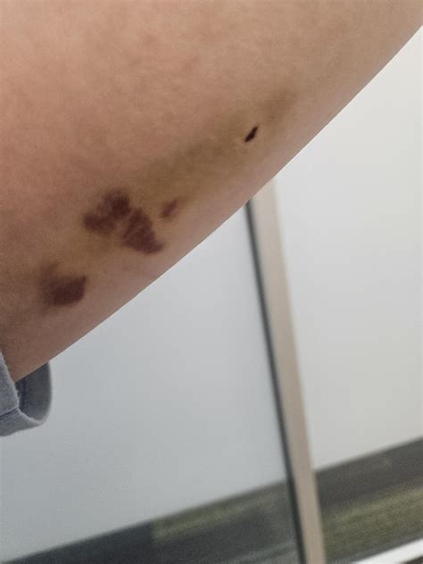 Nexplanon Healing Update : r/Nexplanon