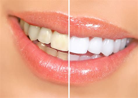 Is Teeth Whitening Worth It? Pros and Cons Revealed!