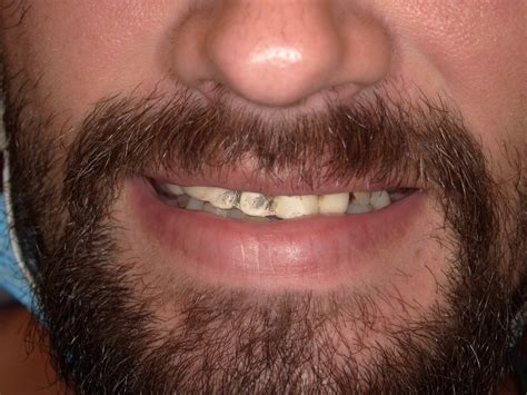 Smile Makeover - 1 - Todd Fincher DDS