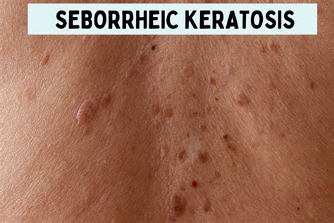 sebaceous hyperplasia  seborrheic keratosis  jake spragg blog