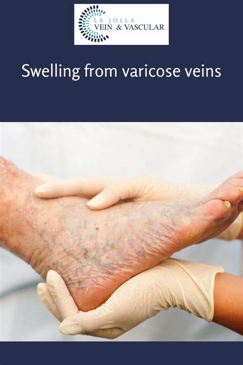 Swelling and varicose veins