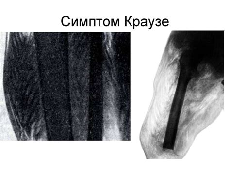 Острая анаэробная клостридиальная инфекция. Диагностика - презентация ...