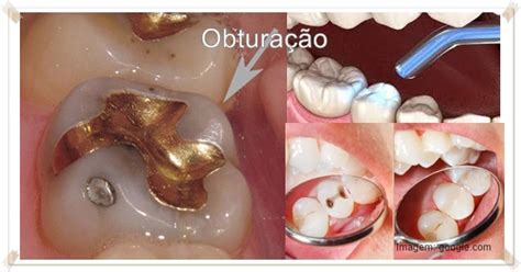 Dente Obturado Doendo O Que Fazer