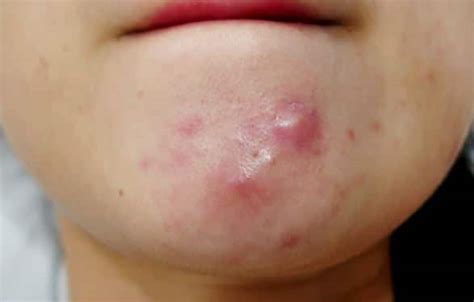 pimples  chin   chin hard painful  rid  small deep