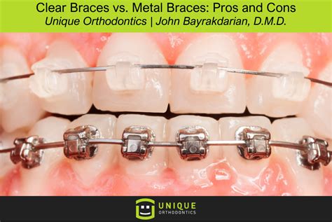 clear braces  metal braces pros  cons unique orthodontics