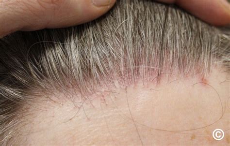 Lichen Planus Scalp Treatment