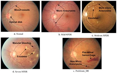 Diabetic Retinopathy Stages