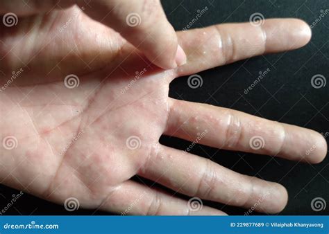 Dyshidrotic Eczema And Food Allergies at Ethan Fuhrman blog