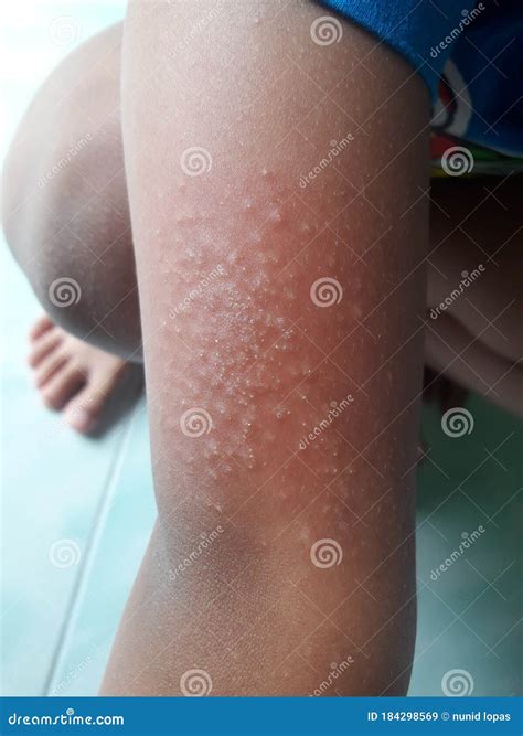 Pruritus Rash Treatment at Jerry Wuest blog