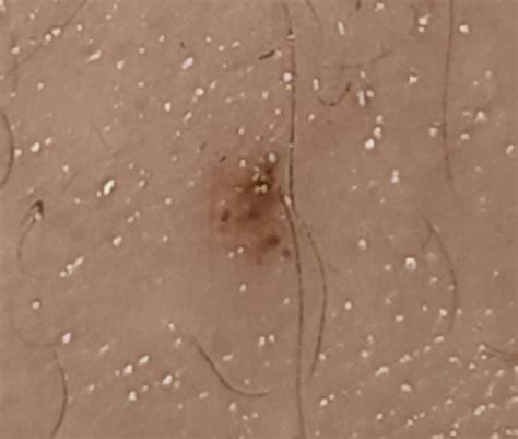 abnormal mole growing hair, should I be worried? : r/DermatologyQuestions