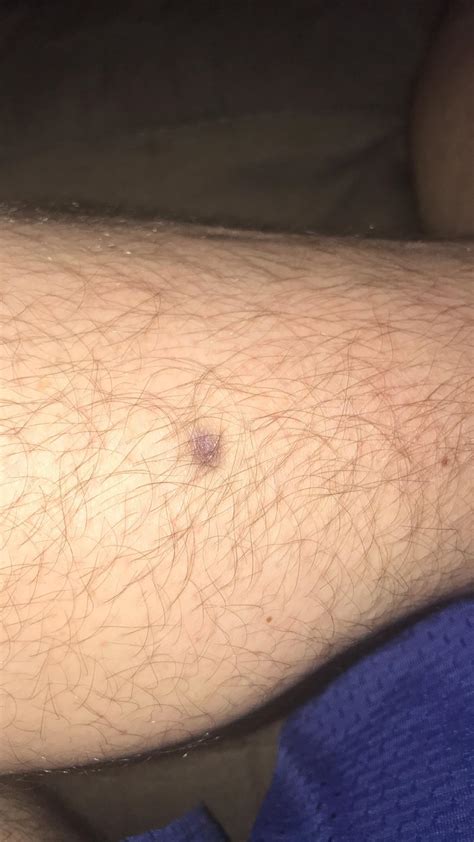 Any clue as to what this could be? Right calf, slightly indented, and