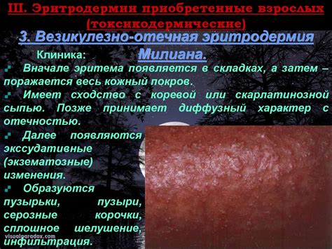 Эритродермии (эксфолиативный дерматит) - презентация онлайн