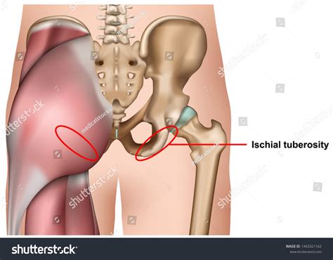 Ischial Tuberosity Photos and Images & Pictures | Shutterstock