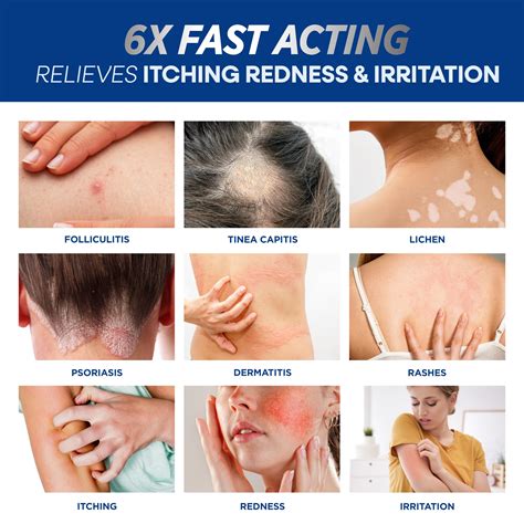Scalp Folliculitis Cure Folliculitis Decalvans