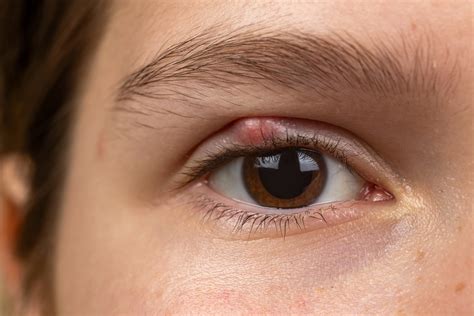 chalazion  symptoms  treatment thea