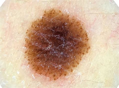 understanding   types  moles spot check clinic skin