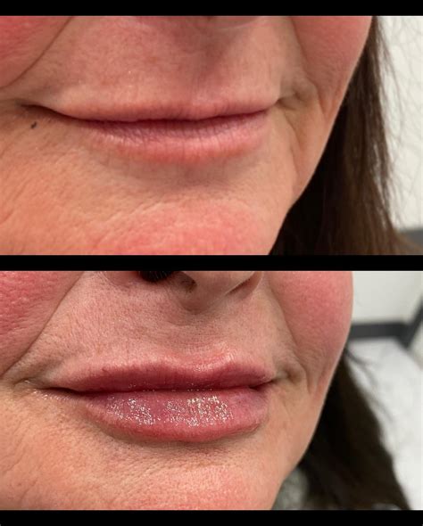 Lip Filler and Lip Flip - Skin Deep Aesthetics