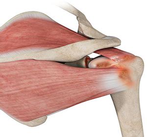 rotator cuff arthropathy washington state reverse shoulder replacement