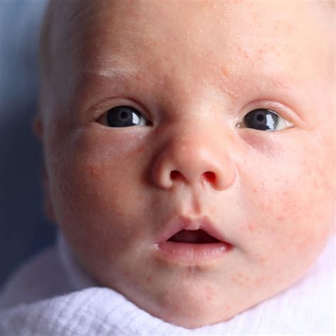 newborn  white bumps   face infoupdateorg