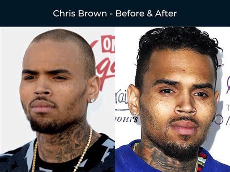 black celebrity hair transplants