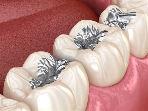 Black Spots Inside My Mouth? | 3D Dentistry in Bradenton, FL