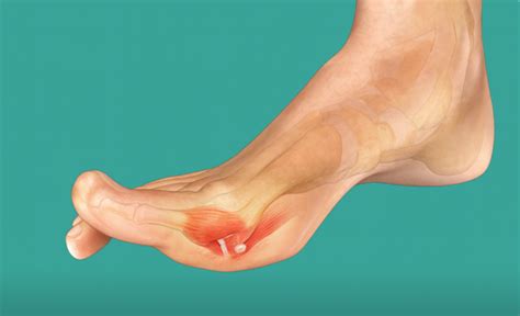 Understanding Turf Toe | Upperline Health