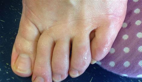 Excessive Sweat On Feet at Emma Ake blog