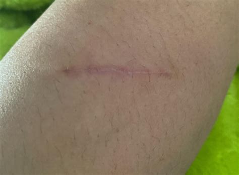 Is this nail melanoma : r/Melanoma