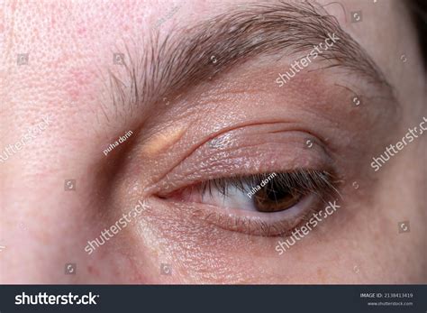 2,283 Yellow Eyelids Images, Stock Photos, 3D objects, & Vectors ...