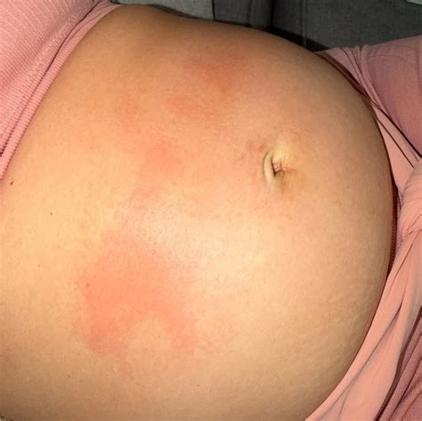 Mancha Na Barriga O Que Pode Ser - Patrícia Leitte mostra manchas na barriga e cogita: 'Urticária gravídica?'