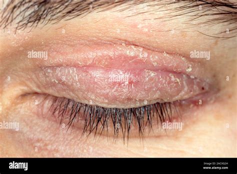 Close-up of flaking skin on the eyelid of a 22 year old woman with