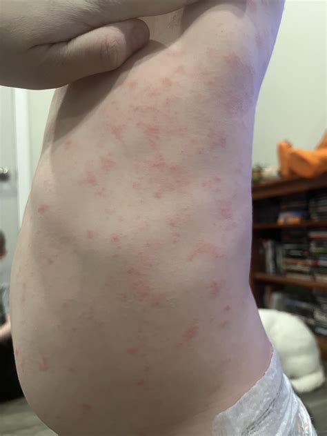 She’s been told in the past she was allergic to peanuts, eggs and dairy