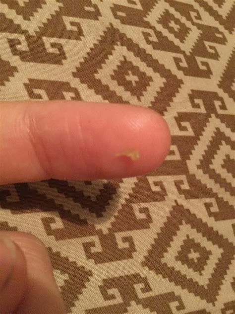 Dermatologists suggest new methods on how to get a blackhead out of an ear 21