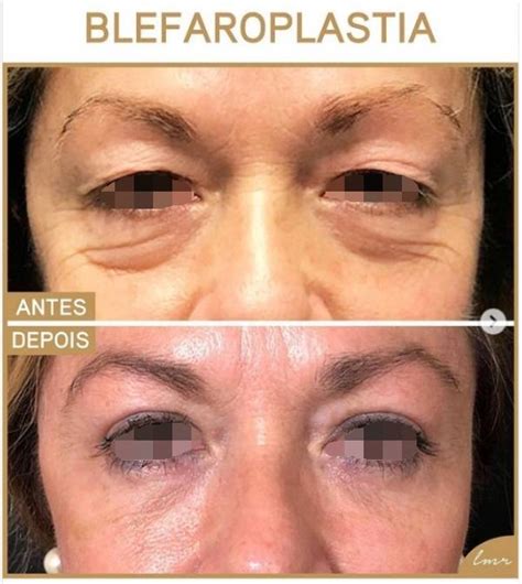 Blefaroplastia Recuperação Dia A Dia - 45 Fotos de Blefaroplastia Antes e Depois do Procedimento – Tá Chique