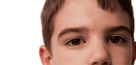 molluscum contagiosum natural treatment rhpb