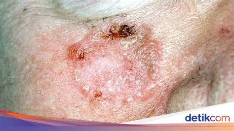 kanker kulit penyebab gejala jenis hingga ciri cirinya