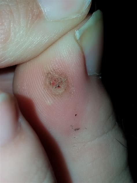 Plantar wart? Has been picked at. : r/popping