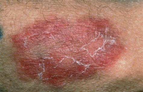 pellagra stock image  science photo library