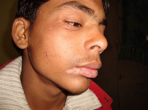 Visible recovery in case of Herpes followed by lip vitiligo with