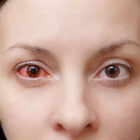 How Do You Get Conjunctivitis 2