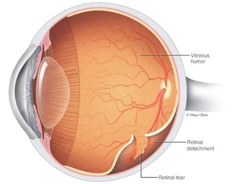 retinal tear  england retina care